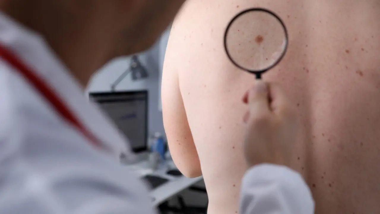5 Critical Signs of Skin Cancer You Should Never Overlook